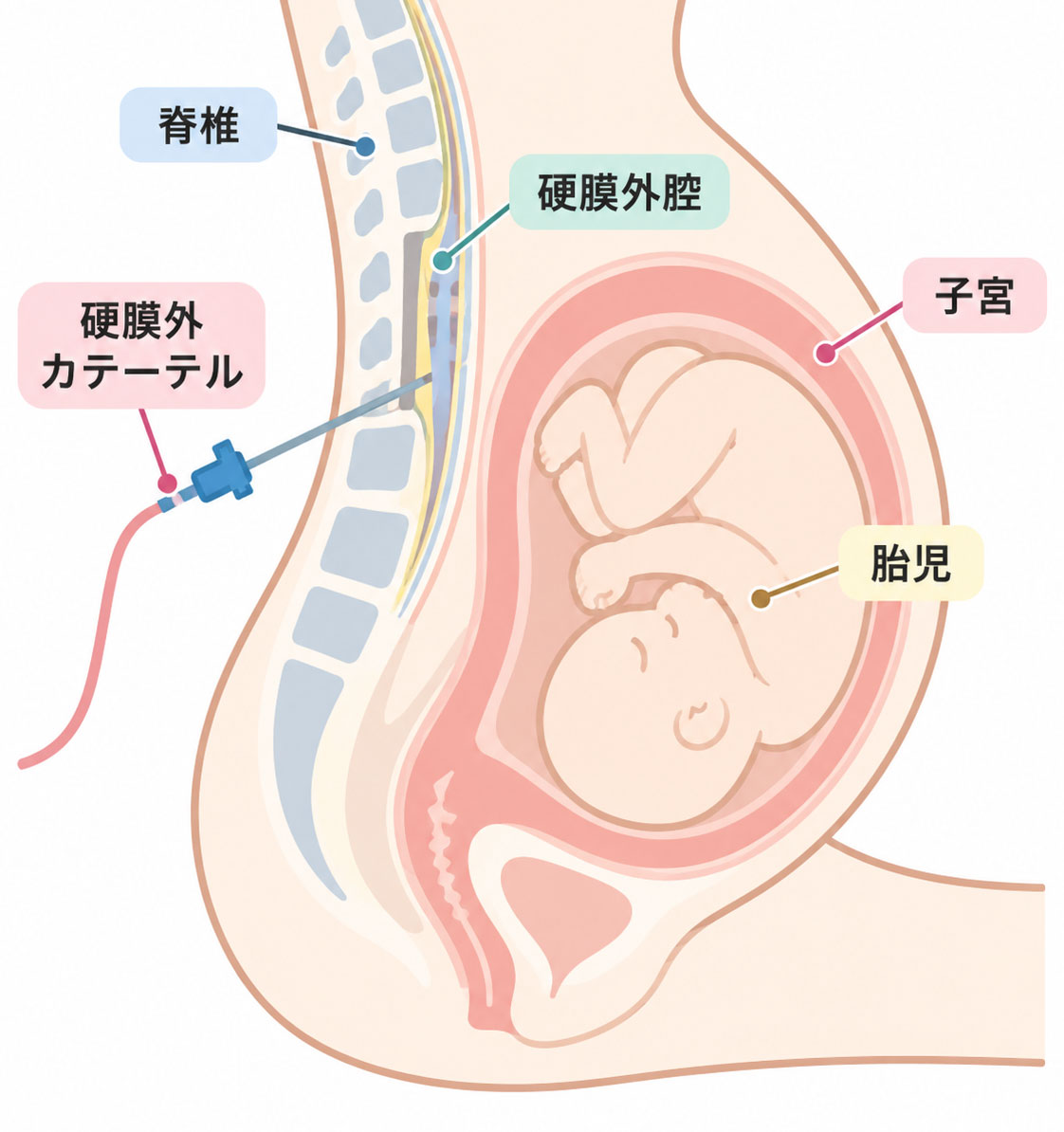 硬膜外麻酔